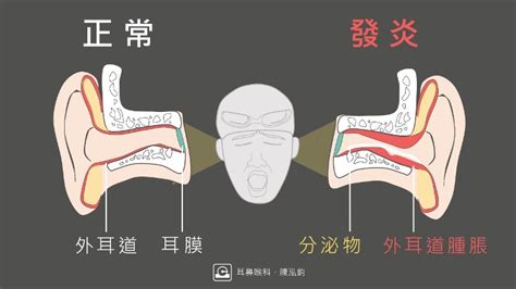 耳骨發炎腫起來|耳朵痛又癢，關於急性外耳炎您該知道的事 